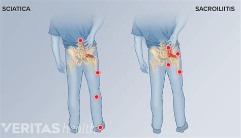 sacroiliitis vs si joint dysfunction